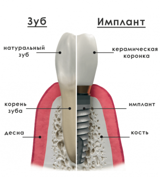 Як проводиться імплантація верхніх передніх зубів