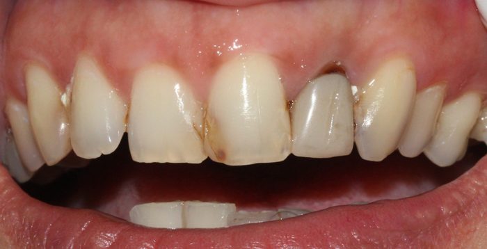 Карієс на передніх зубах: причини, симптоми і методи лікування
