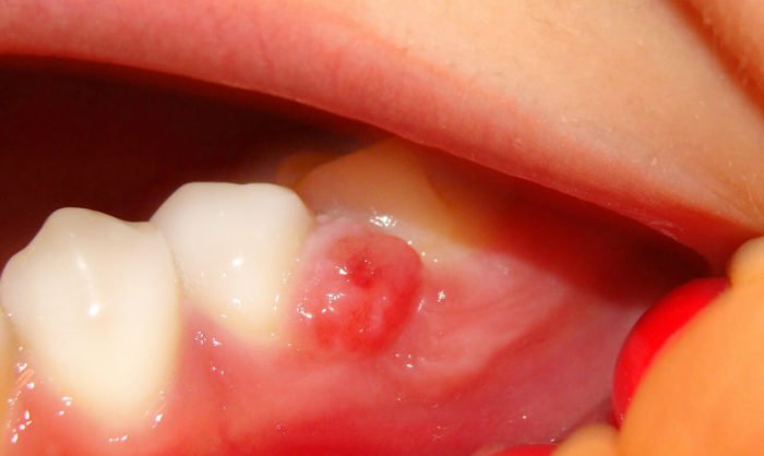 Кіста зуба: симптоми, причини виникнення і методи лікування