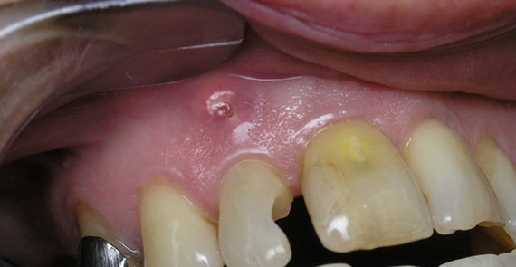 Кістогранульома зуба: причини, симптоми, методи лікування та профілактики
