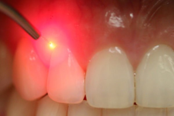 Лікування кісти зуба лазером: переваги і недоліки методу