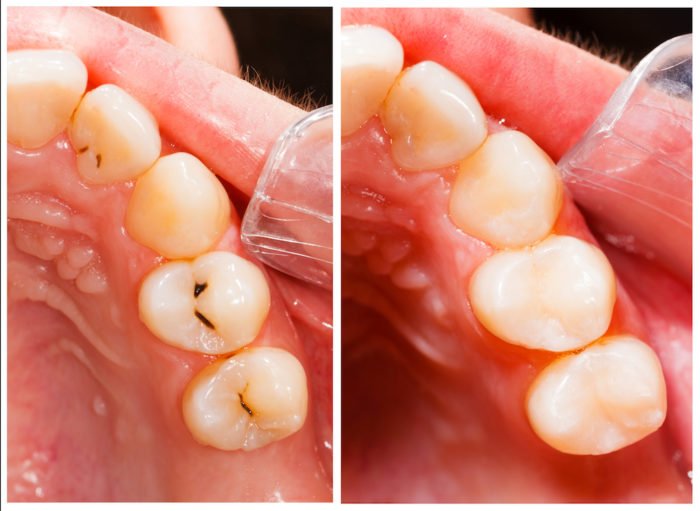 Чи можна вагітним пломбувати зуби: показання та протипоказання