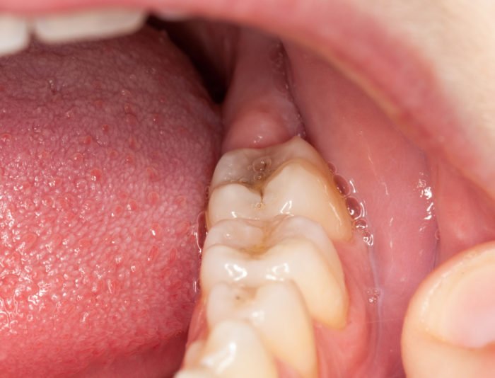Чи можна видаляти зуб при флюсі: показання та протипоказання