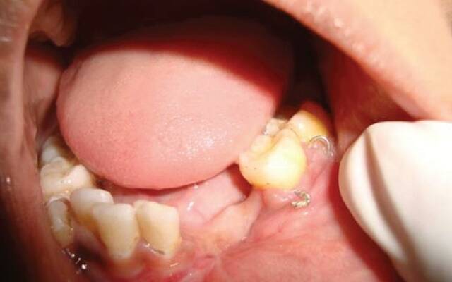 Чи можна видаляти зуб при флюсі: показання та протипоказання