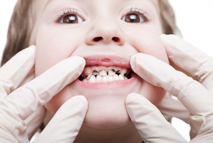 Потрібно пломбувати молочні зуби: які пломби ставлять і є сенс