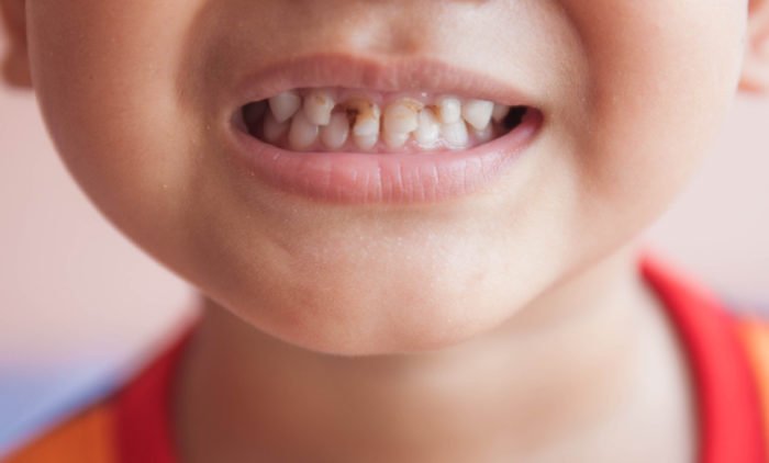 Потрібно пломбувати молочні зуби: які пломби ставлять і є сенс