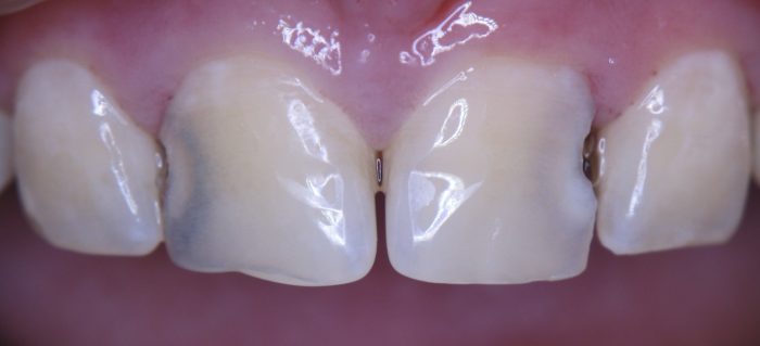 Почорнів зуб під пломбою: причини і методи лікування