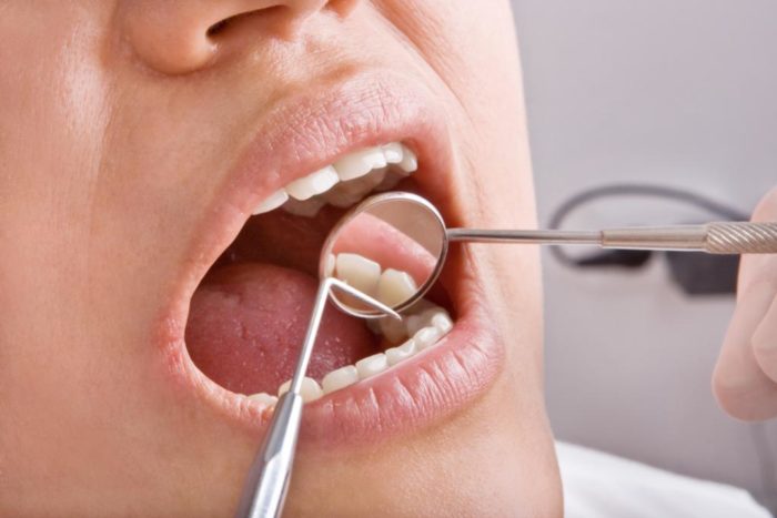 Після видалення зуба мудрості не відкривається рот: причини і лікування