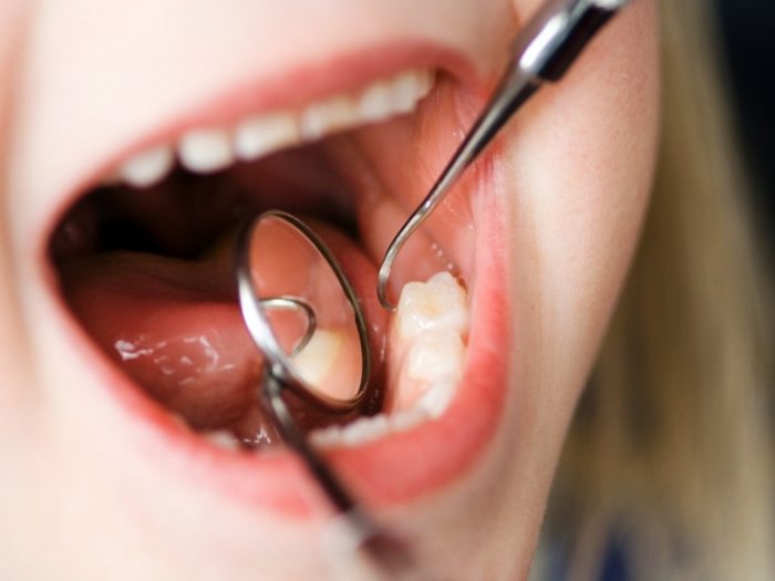 При жуванні болить запломбований зуб: причини і методи лікування