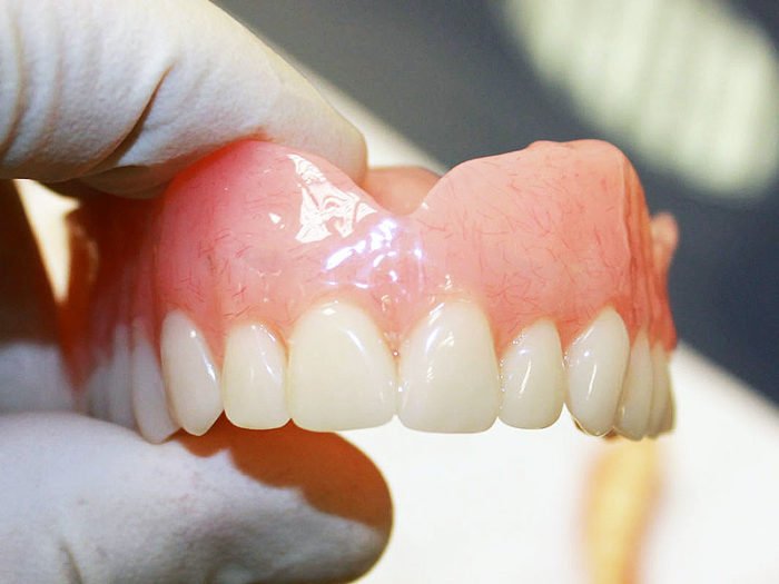 Протезування зубів при пародонтозі: для чого проводиться, види і опис імплантів
