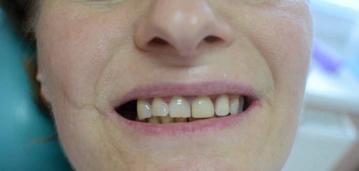 Протезування зубів при пародонтозі: для чого проводиться, види і опис імплантів