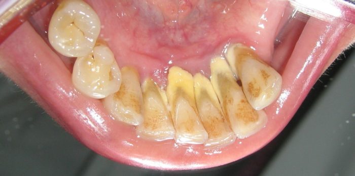 Шкаралупа волоського горіха від зубного каменю: особливості застосування