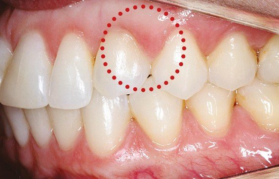 Стадії та види карієсу: опис ступенів каріозного ураження зубів