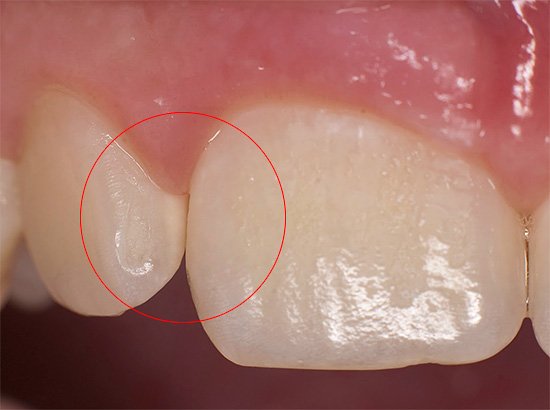 Стадії та види карієсу: опис ступенів каріозного ураження зубів