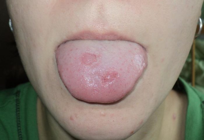 Виразки на язиці у дитини: причини, методи діагностики та лікування